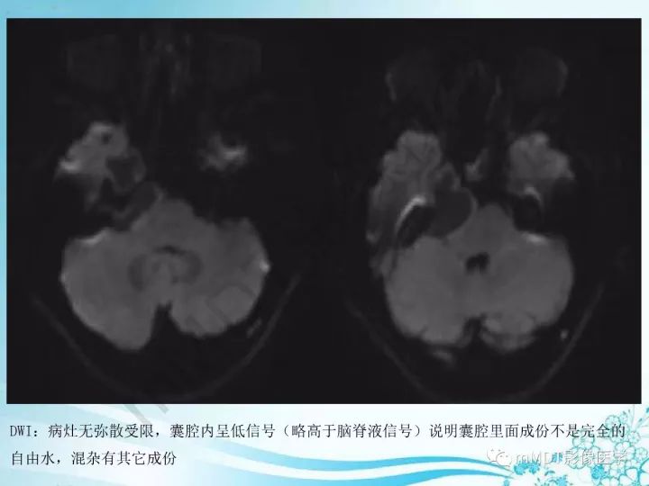 【PPT】听神经鞘瘤