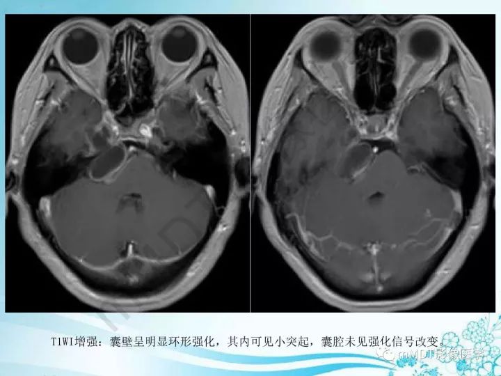 【PPT】听神经鞘瘤