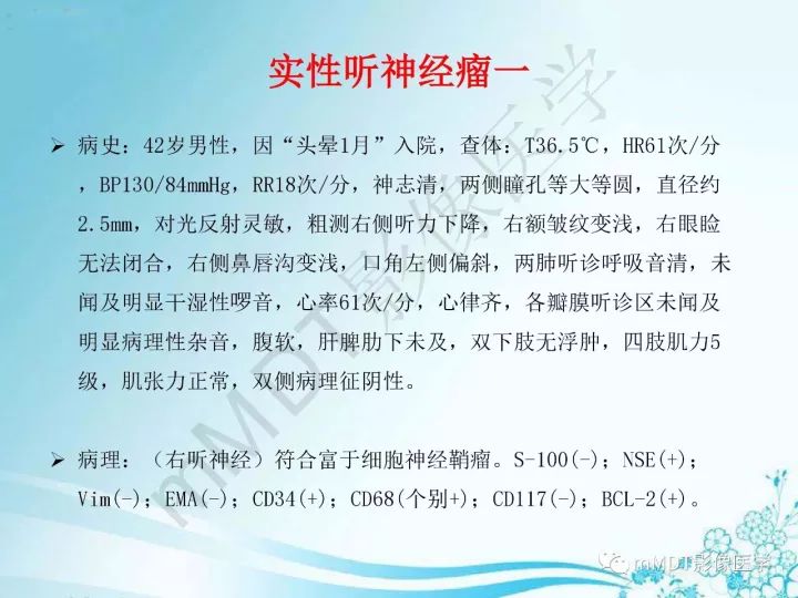 【PPT】听神经鞘瘤