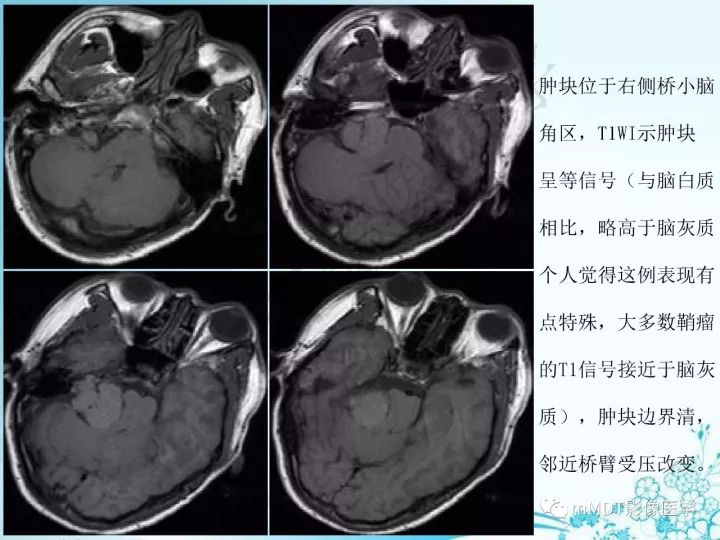 【PPT】听神经鞘瘤