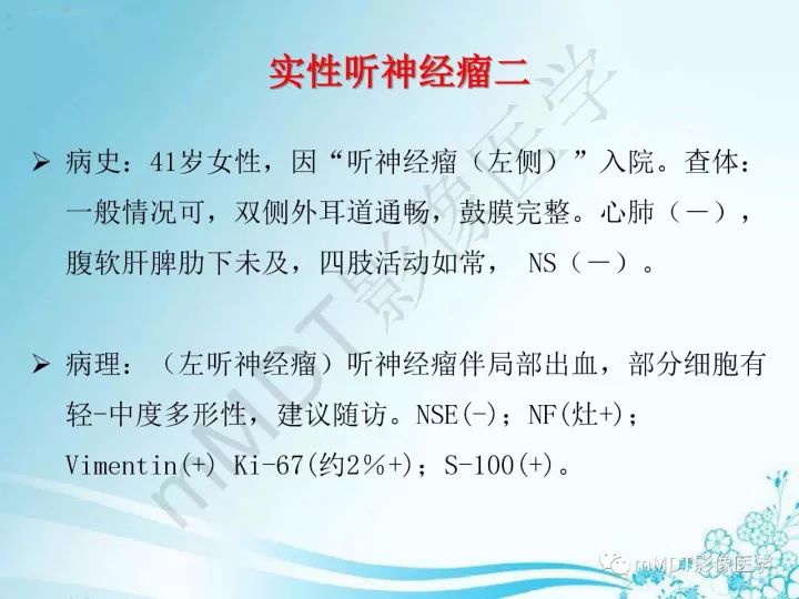 【PPT】听神经鞘瘤