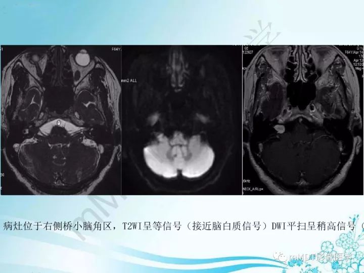 【PPT】听神经鞘瘤
