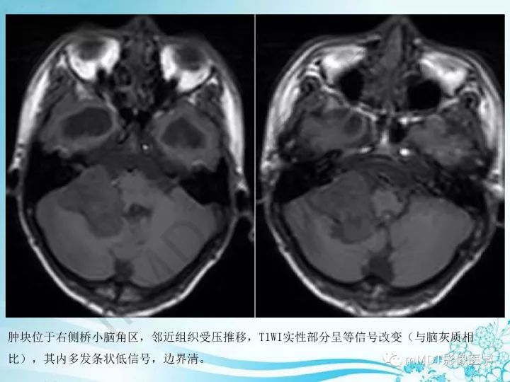 【PPT】听神经鞘瘤