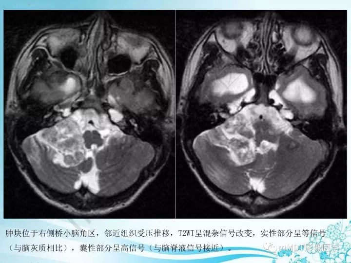 【PPT】听神经鞘瘤