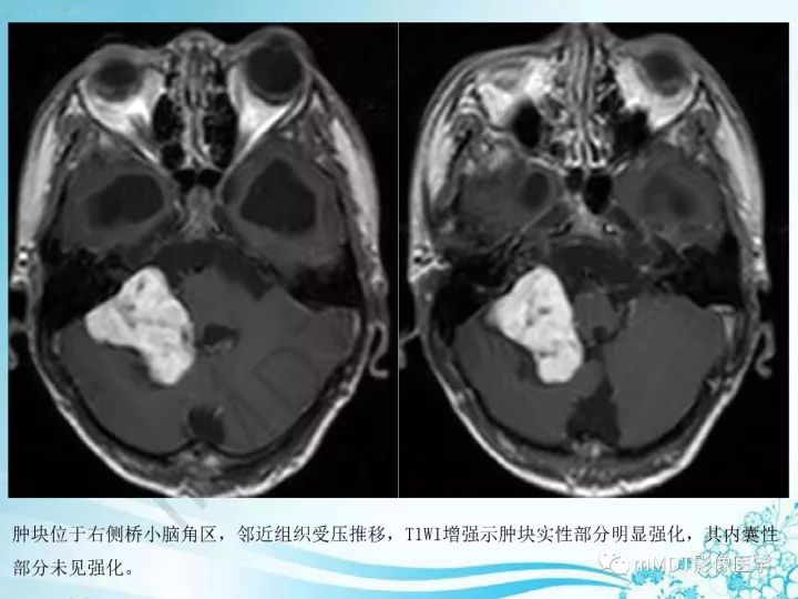 【PPT】听神经鞘瘤