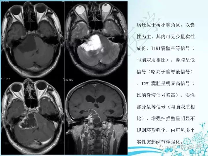 【PPT】听神经鞘瘤