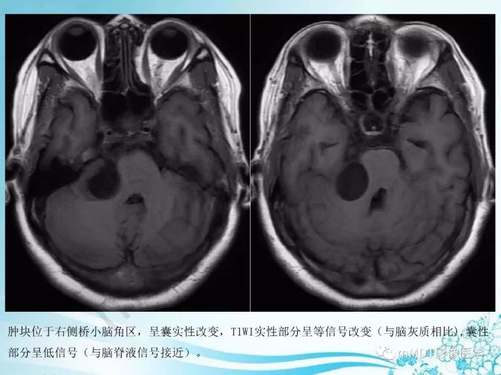 【PPT】听神经鞘瘤