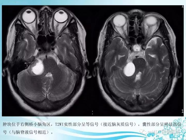 【PPT】听神经鞘瘤