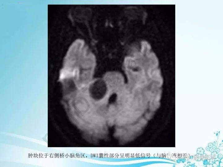 【PPT】听神经鞘瘤