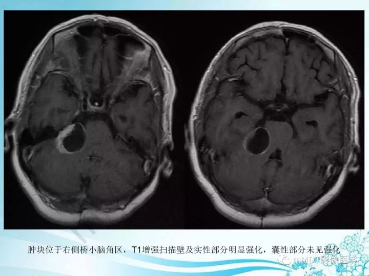 【PPT】听神经鞘瘤