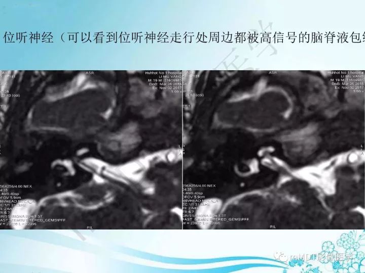 【PPT】听神经鞘瘤