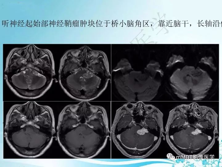 【PPT】听神经鞘瘤