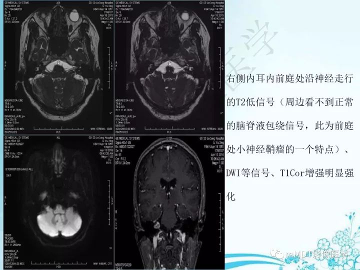 【PPT】听神经鞘瘤