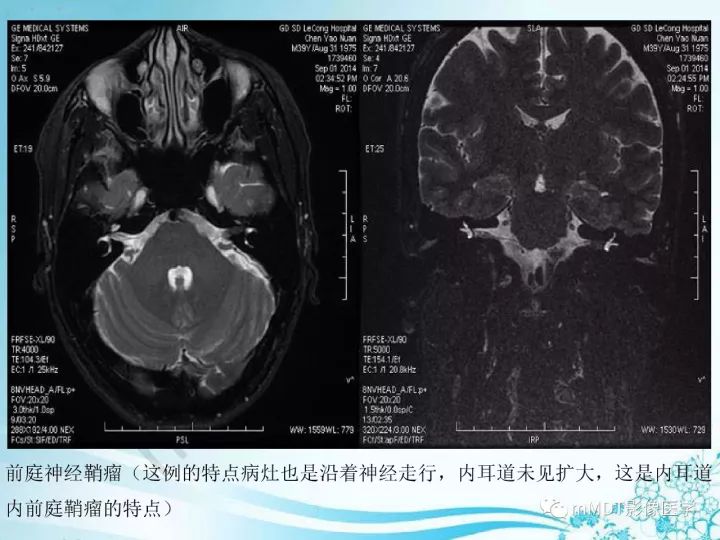 【PPT】听神经鞘瘤