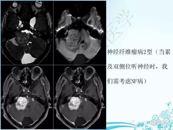 【PPT】听神经鞘瘤