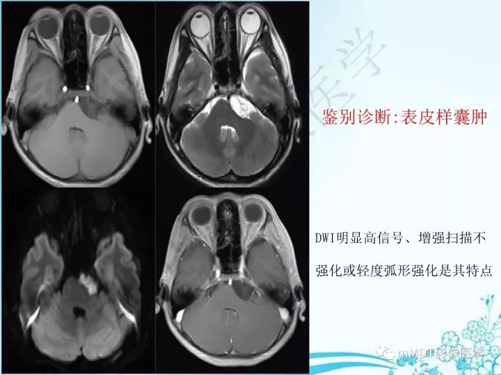 【PPT】听神经鞘瘤