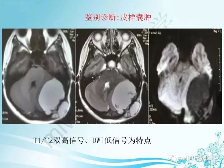 【PPT】听神经鞘瘤