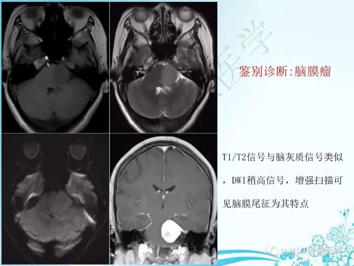 【PPT】听神经鞘瘤