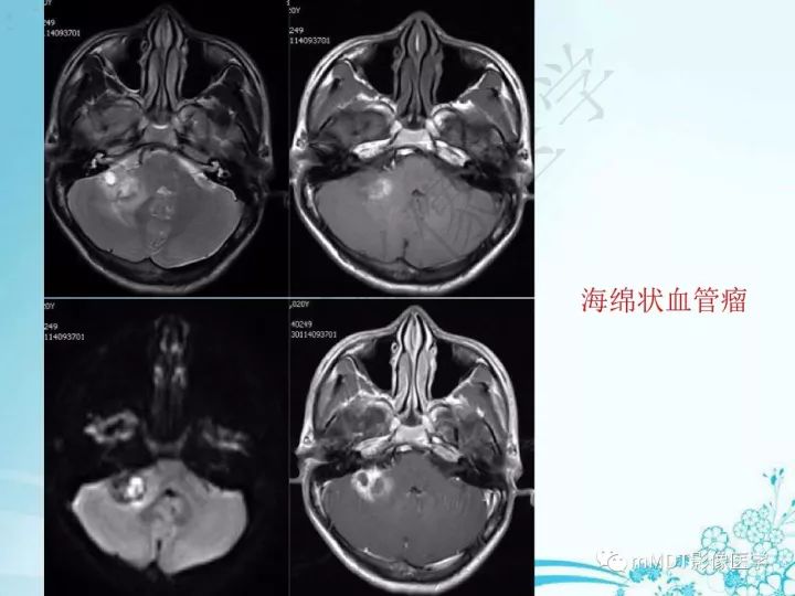 【PPT】听神经鞘瘤