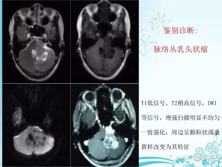 【PPT】听神经鞘瘤