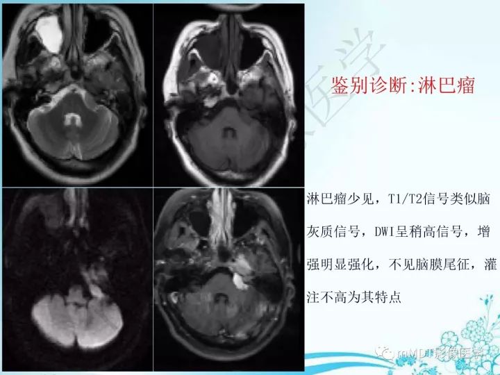 【PPT】听神经鞘瘤