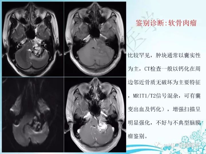 【PPT】听神经鞘瘤