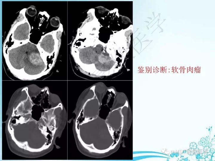 【PPT】听神经鞘瘤