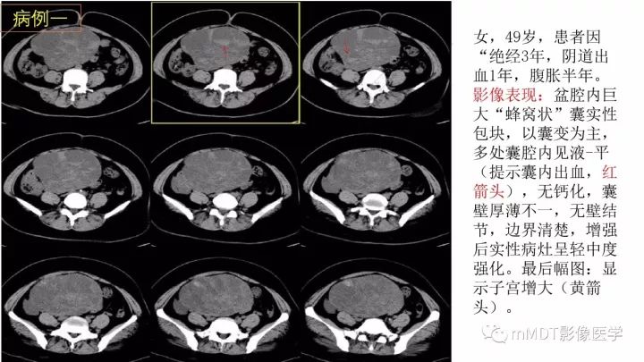 【PPT】常见卵巢性索间质肿瘤