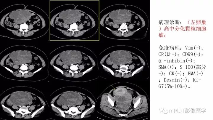 【PPT】常见卵巢性索间质肿瘤