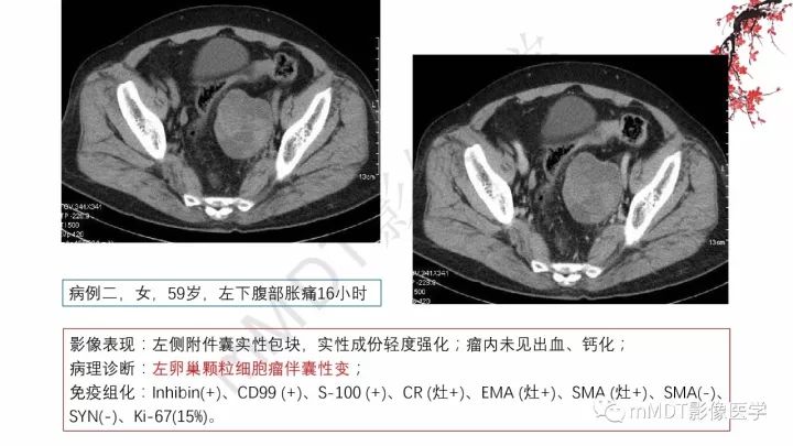 【PPT】常见卵巢性索间质肿瘤