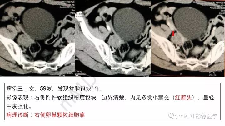 【PPT】常见卵巢性索间质肿瘤