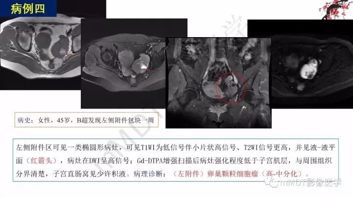 【PPT】常见卵巢性索间质肿瘤