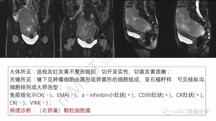 【PPT】常见卵巢性索间质肿瘤