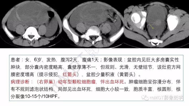 【PPT】常见卵巢性索间质肿瘤