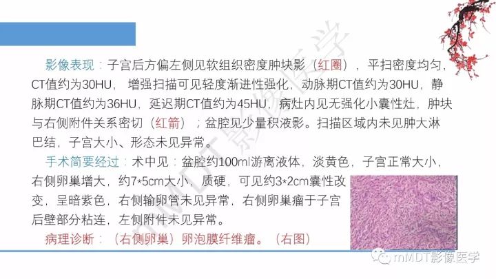 【PPT】常见卵巢性索间质肿瘤