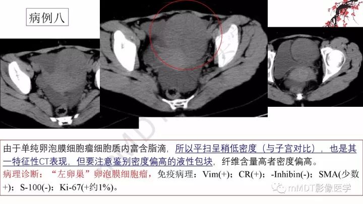 【PPT】常见卵巢性索间质肿瘤