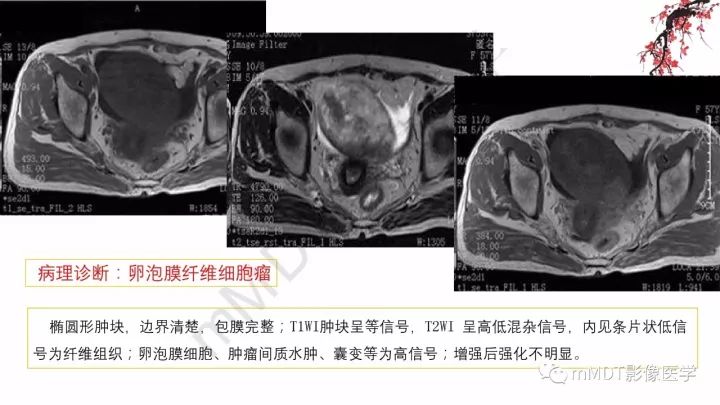 【PPT】常见卵巢性索间质肿瘤