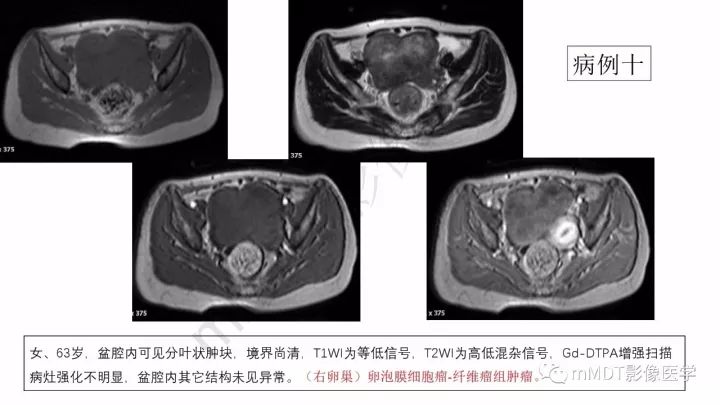 【PPT】常见卵巢性索间质肿瘤