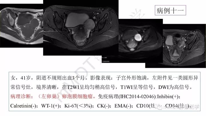 【PPT】常见卵巢性索间质肿瘤