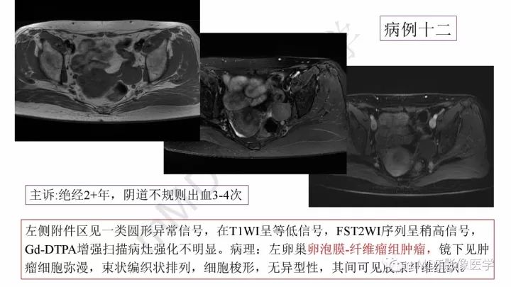 【PPT】常见卵巢性索间质肿瘤