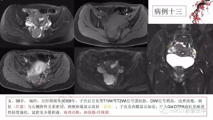 【PPT】常见卵巢性索间质肿瘤