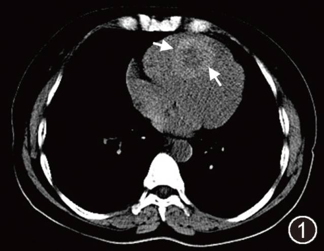 【病例】心内异位甲状腺影像表现一例CT