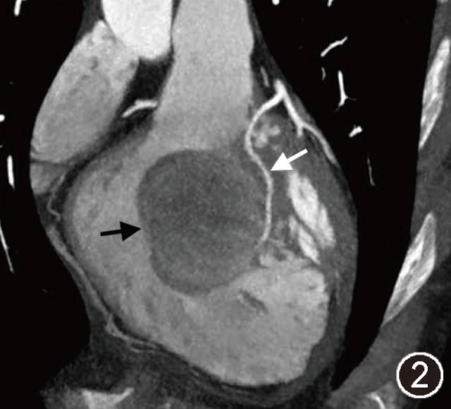 【病例】心内异位甲状腺影像表现一例CT