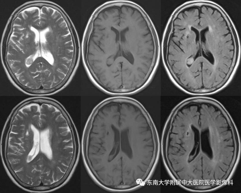 【病例】侧脑室脉络丛乳头状瘤1例MR影像特点