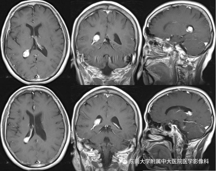 【病例】侧脑室脉络丛乳头状瘤1例MR影像特点
