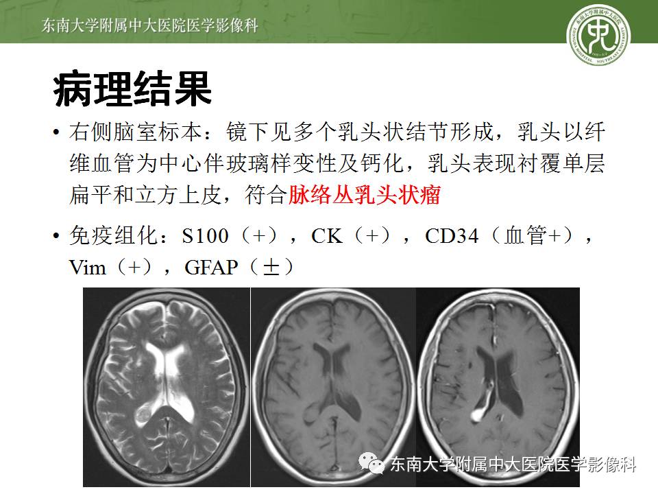【病例】侧脑室脉络丛乳头状瘤1例MR影像特点