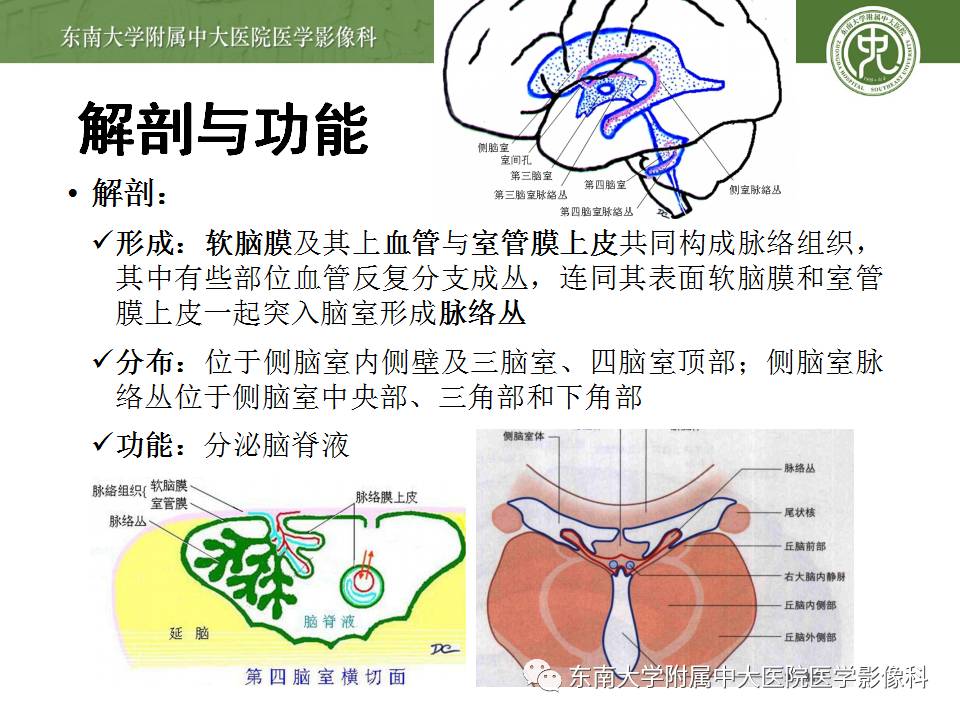 【病例】侧脑室脉络丛乳头状瘤1例MR影像特点