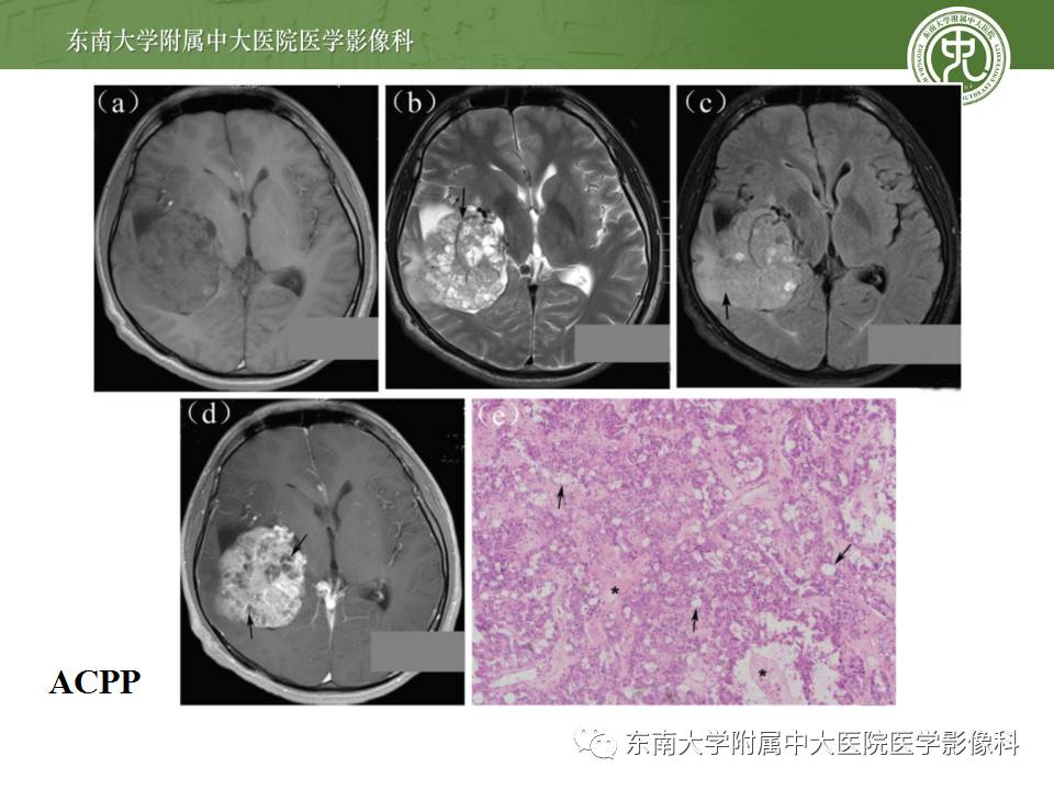 【病例】侧脑室脉络丛乳头状瘤1例MR影像特点