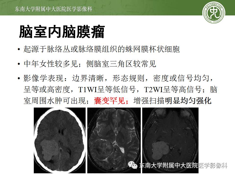 【病例】侧脑室脉络丛乳头状瘤1例MR影像特点