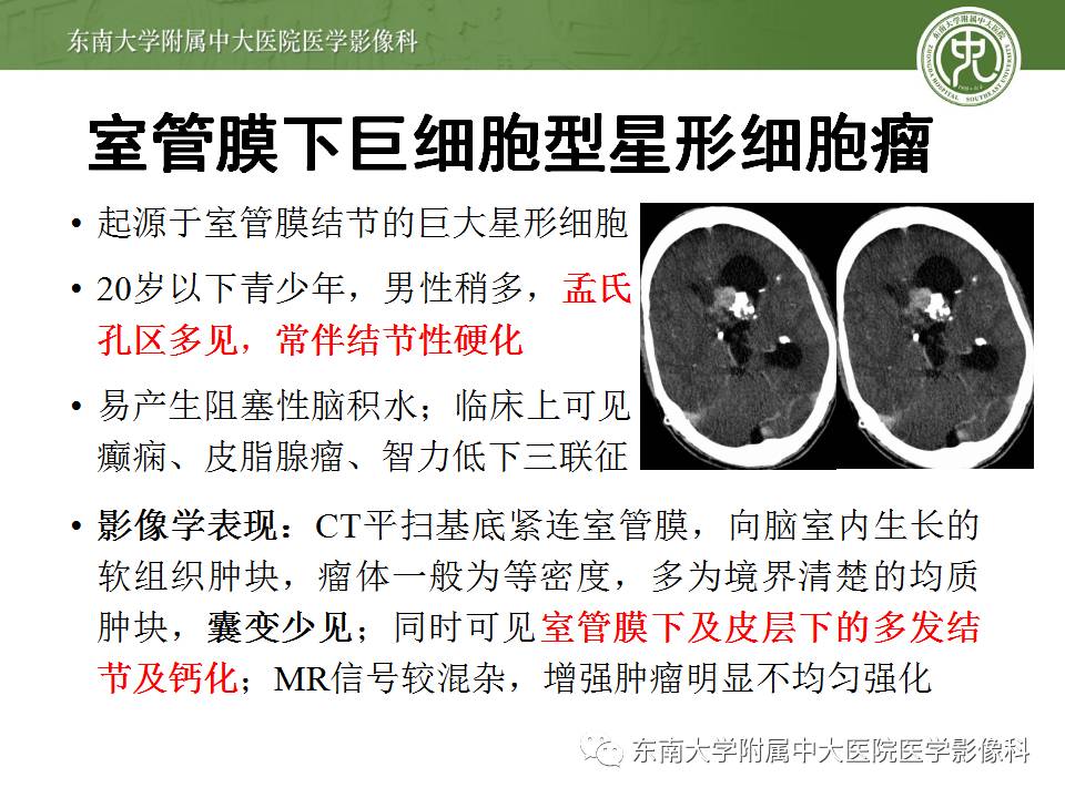 【病例】侧脑室脉络丛乳头状瘤1例MR影像特点